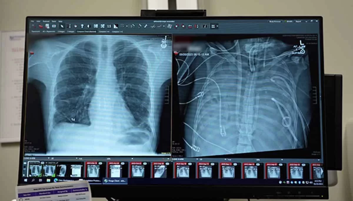Surgeons Achieve Groundbreaking Double Lung Transplant After 48 Hours Without Lungs