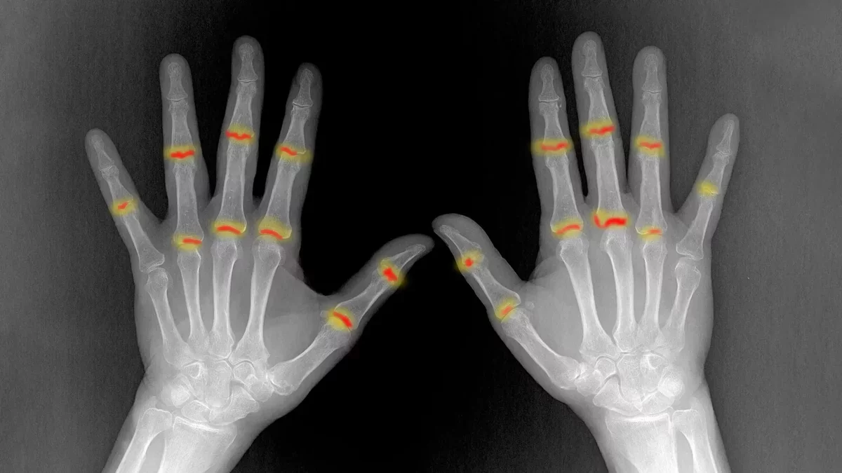 Researchers Discover Mechanism Behind Psoriasis-Induced Joint Disease