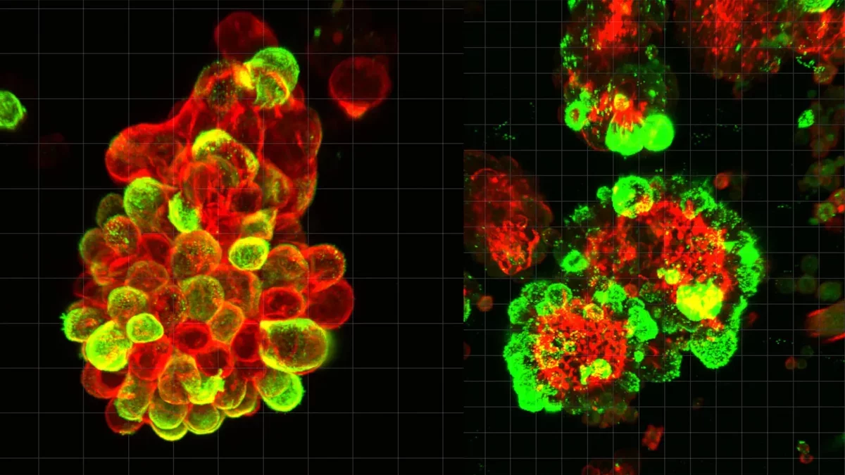 Understanding the Deadly Nature of Ovarian Cancer: A New Study Unveils Insights