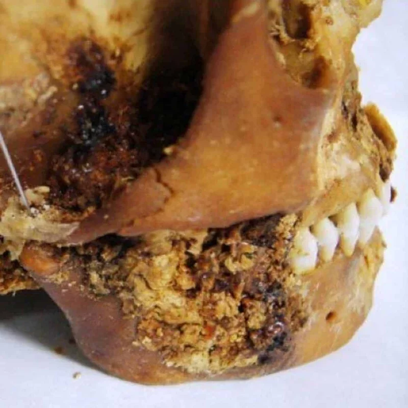 Ancient Surgery Revealed in 2,500-Year-Old Siberian Mummy