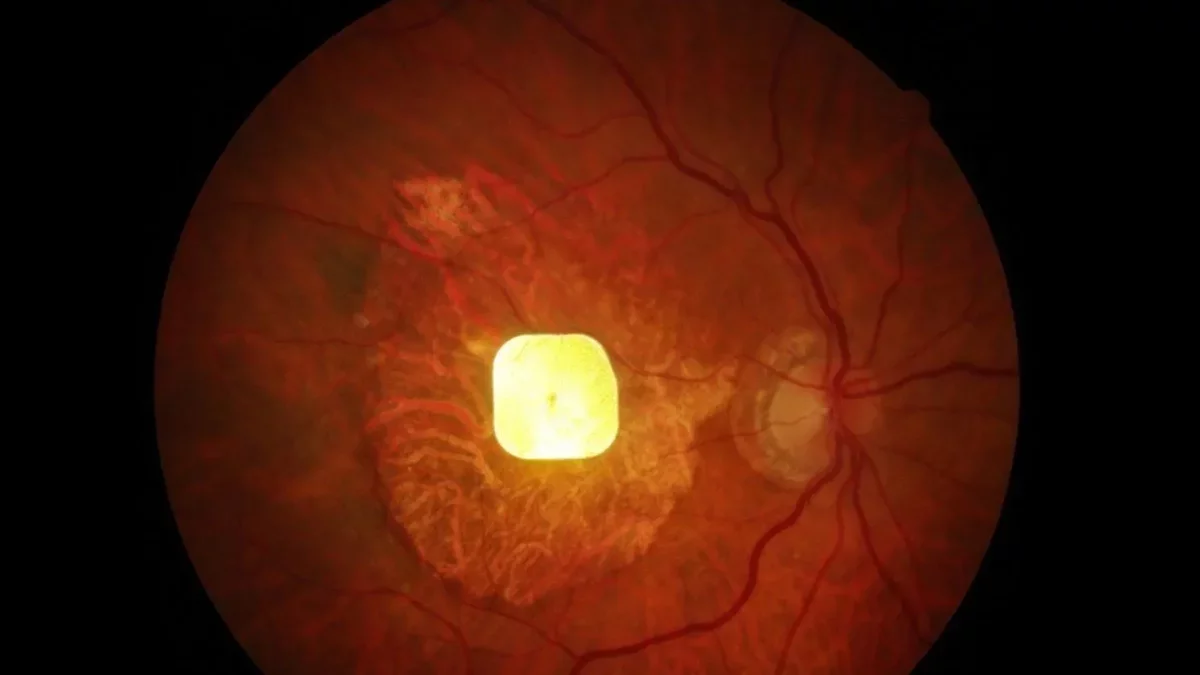 Wireless Retinal Implant Restores Vision for Blind Patients