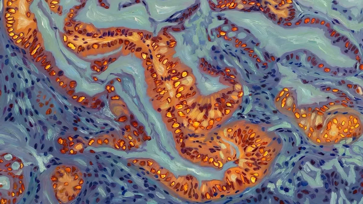 Breakthrough in Pancreatic Cancer Research: Understanding Chemotherapy Resistance