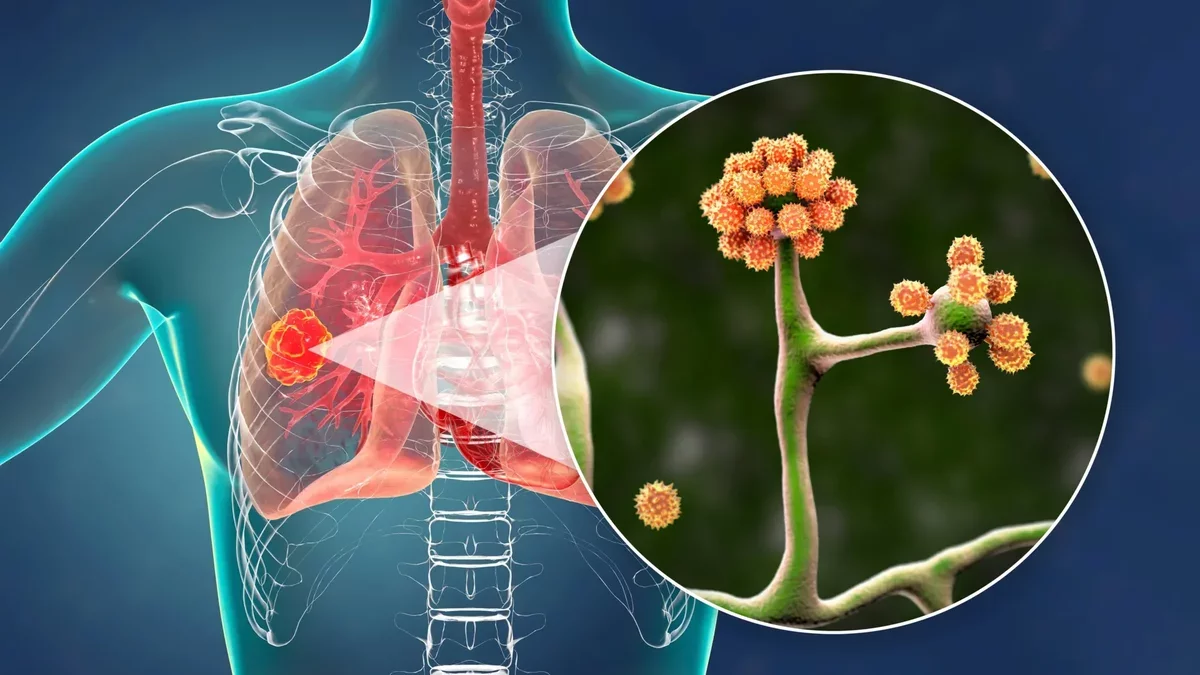 A Promising Blood Protein in the Fight Against Mucormycosis