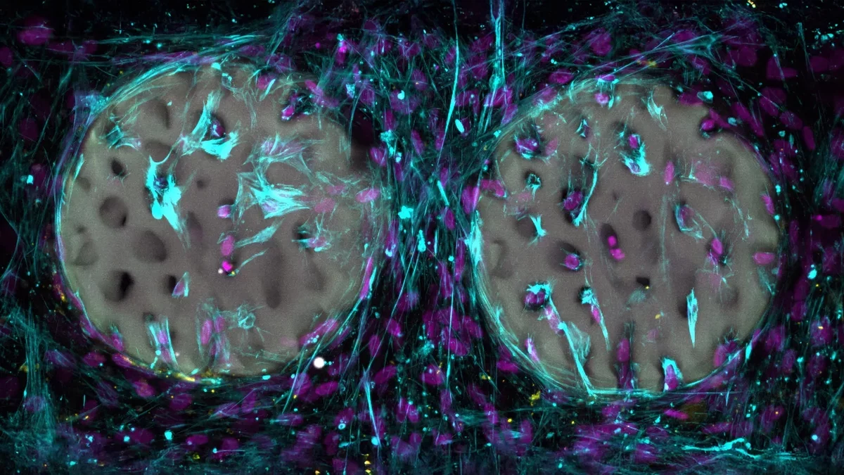 Innovative Hydrogel Implant Could Revolutionize Bone Healing