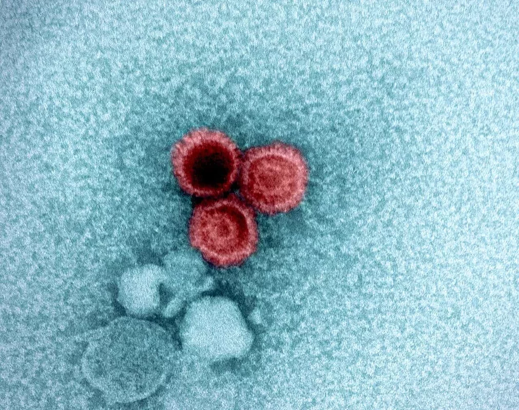 Common Virus Linked to Multiple Sclerosis: New Insights from Research
