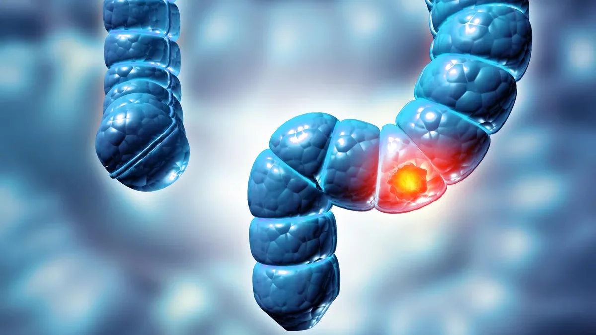 New Study Highlights Importance of Regular Colonoscopies for Bowel Cancer Prevention