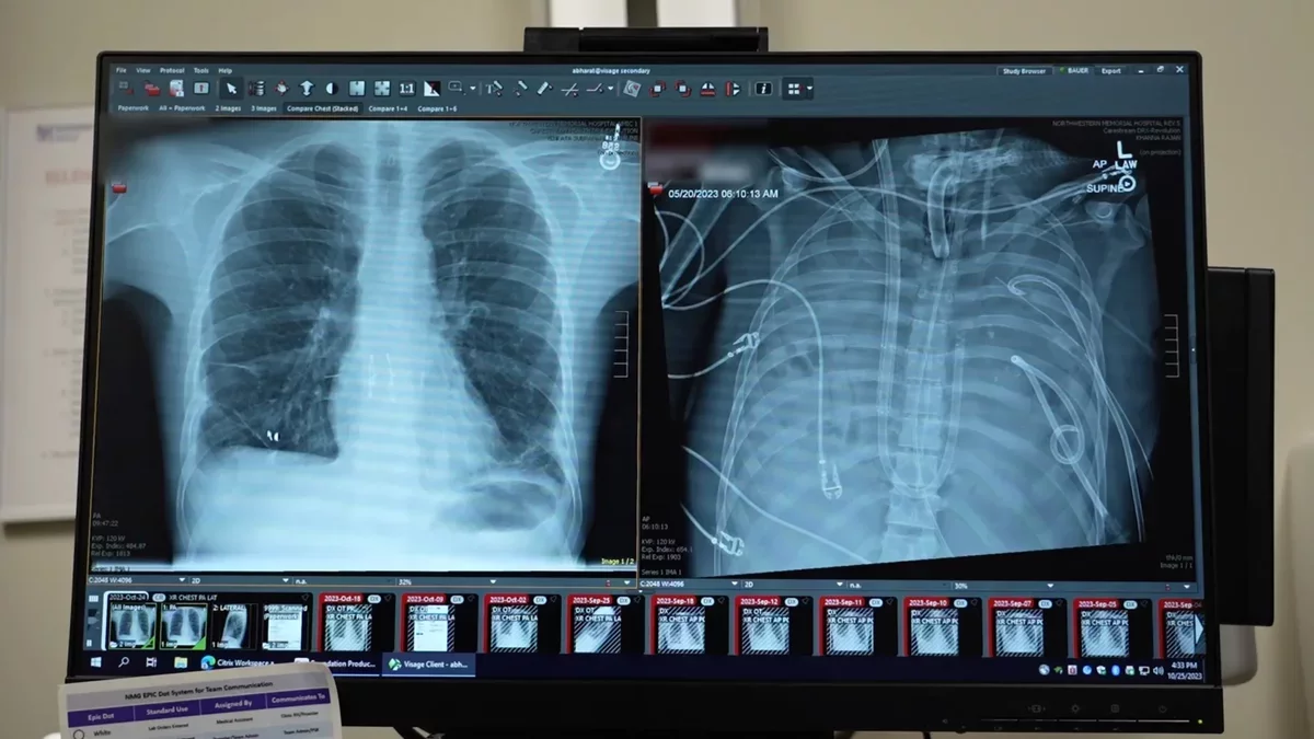 Innovative Artificial Lung System Saves Patient Awaiting Transplant