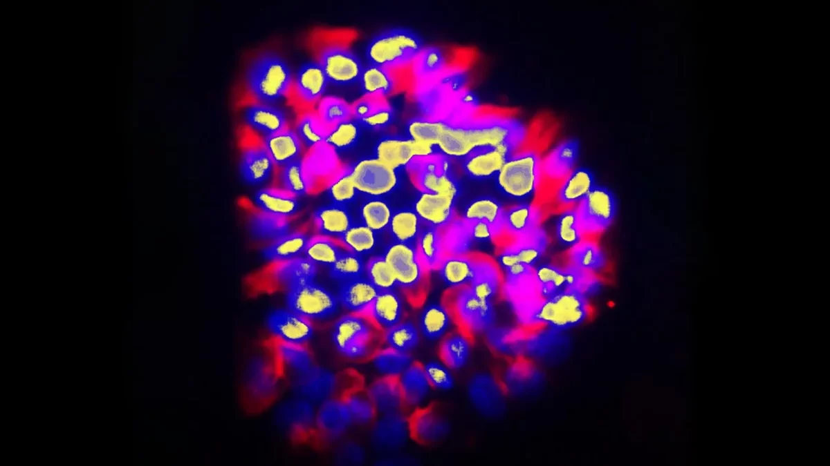 Innovative AI Tool Accurately Forecasts Cancer Metastasis