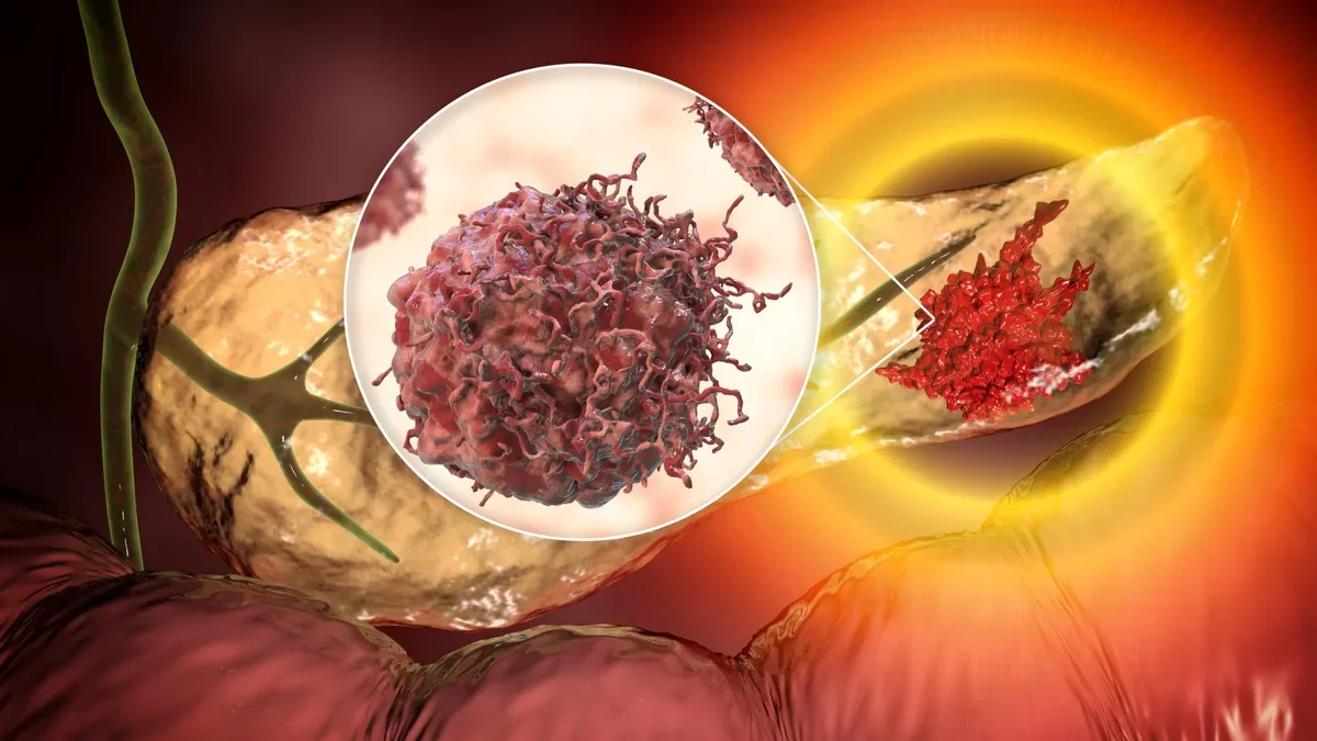 Revolutionary Blood Test Enhances Early Detection of Pancreatic Cancer