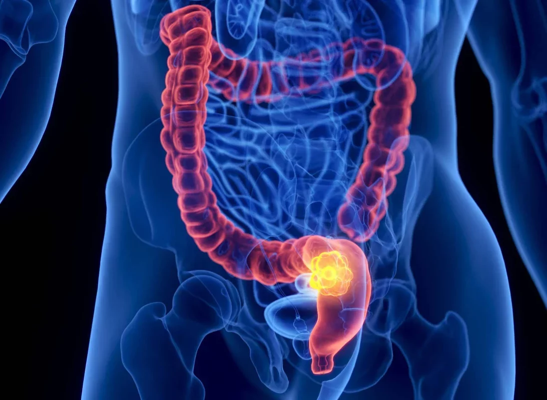 Colorectal Cancer Emerges as Top Cancer Threat for Americans Under 50