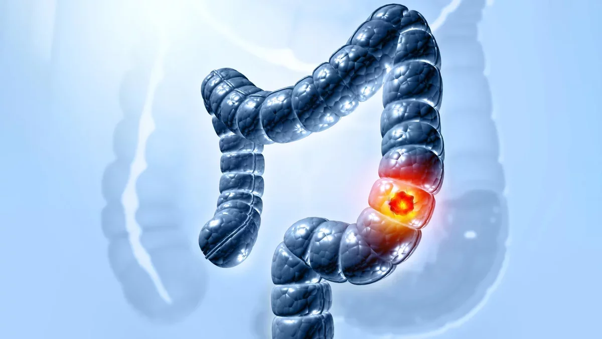 Unveiling a Hidden Virus: A New Insight into Colon Cancer