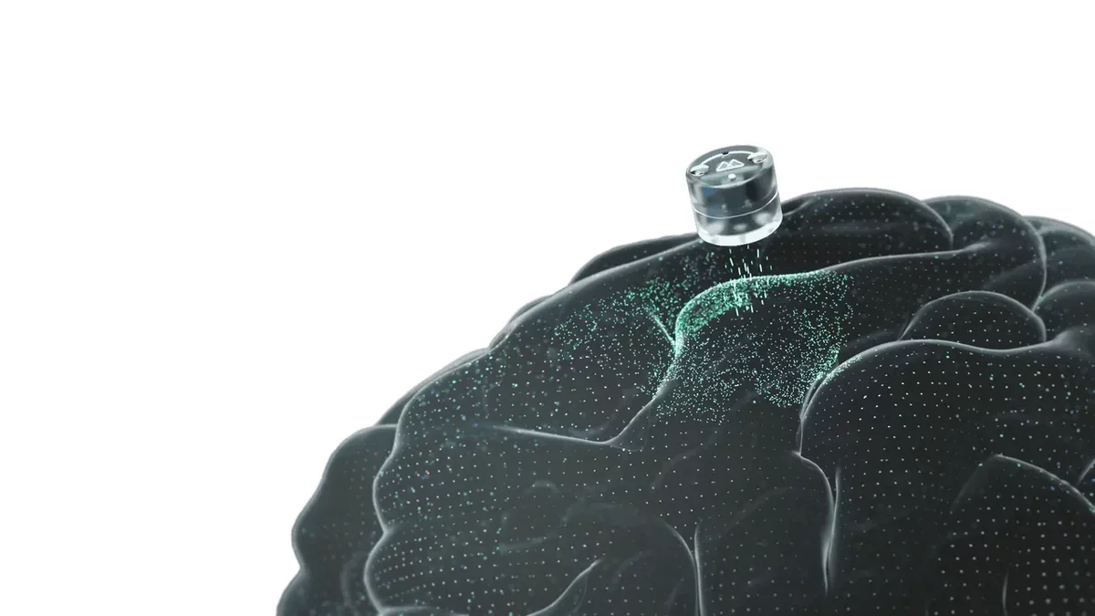 Innovative Skull Implant for Depression Treatment Completes Initial Trials