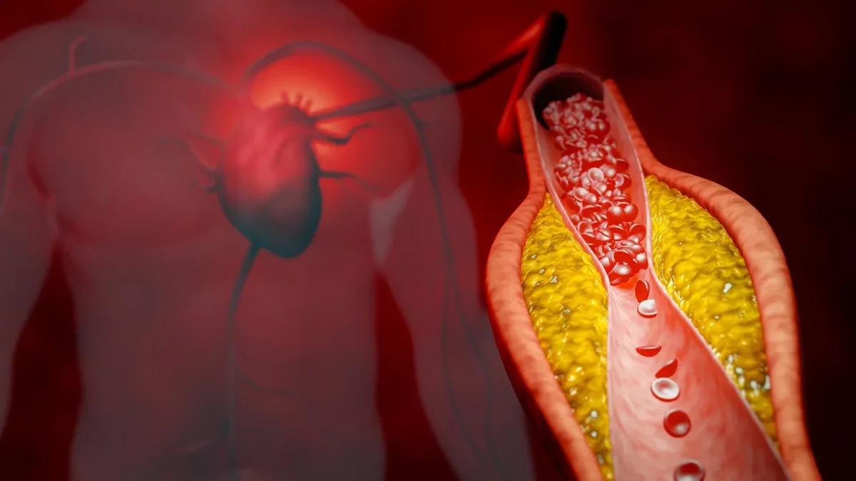 Innovative Treatment Reduces Bad Cholesterol by Nearly 50% Without Statins