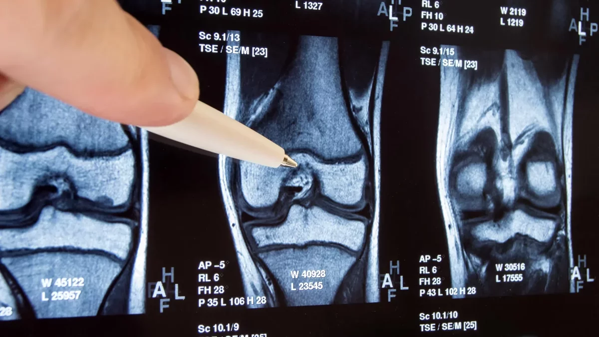 Reevaluating Common Knee Surgery: New Study Questions Effectiveness