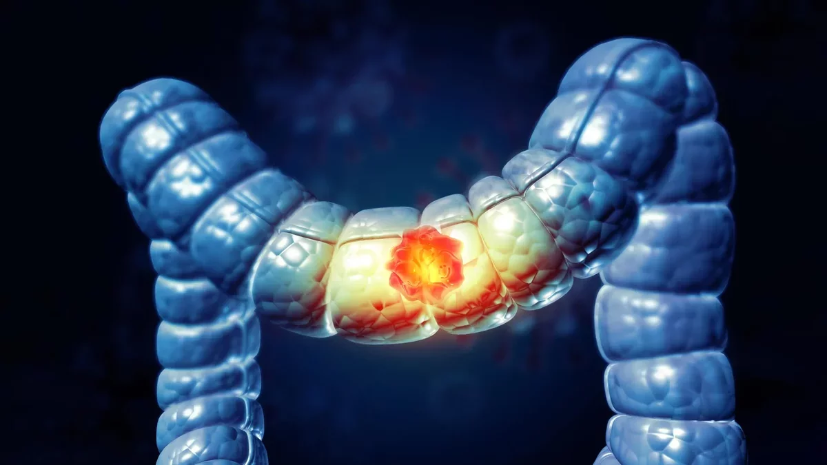 Rising Rates of Colorectal Cancer Among Young Adults: A Call for Awareness