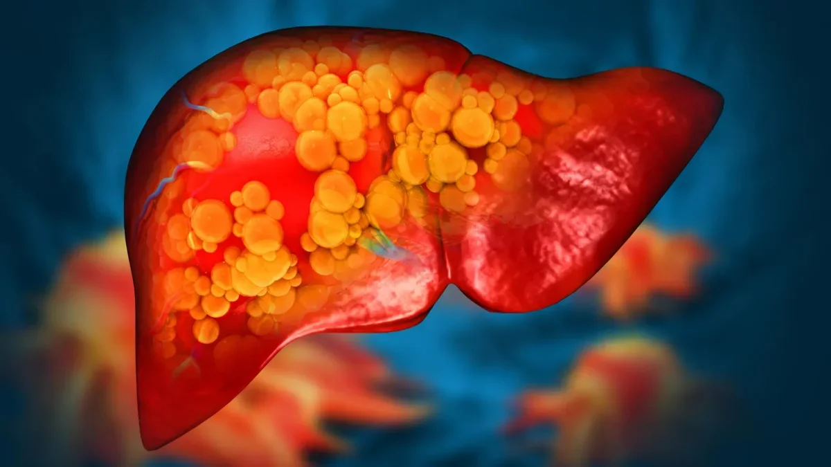 Innovative Drug Shows Promise in Treating Fatty Liver Disease