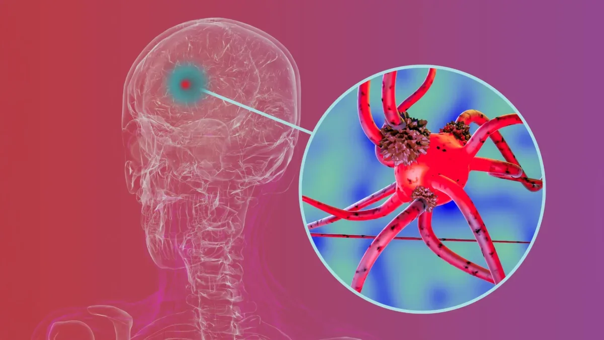 Breakthrough in Parkinson's Research: Blocking Key Protein Offers Hope