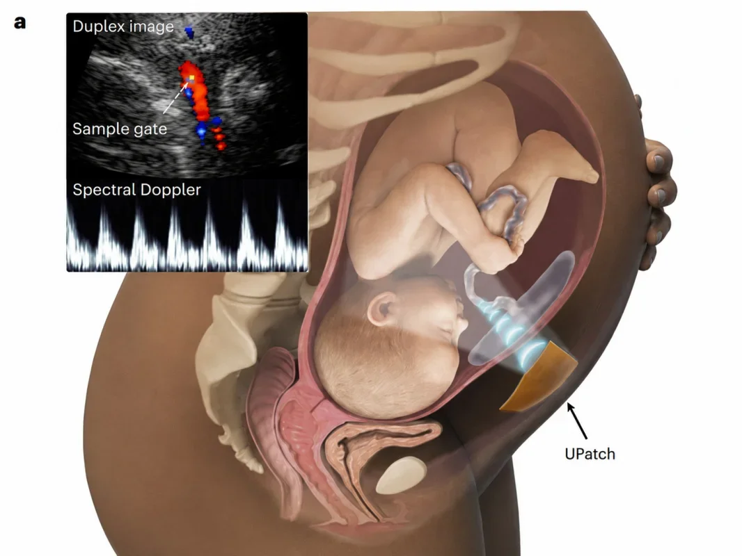Revolutionary Wearable Ultrasound Patch for High-Risk Pregnancies
