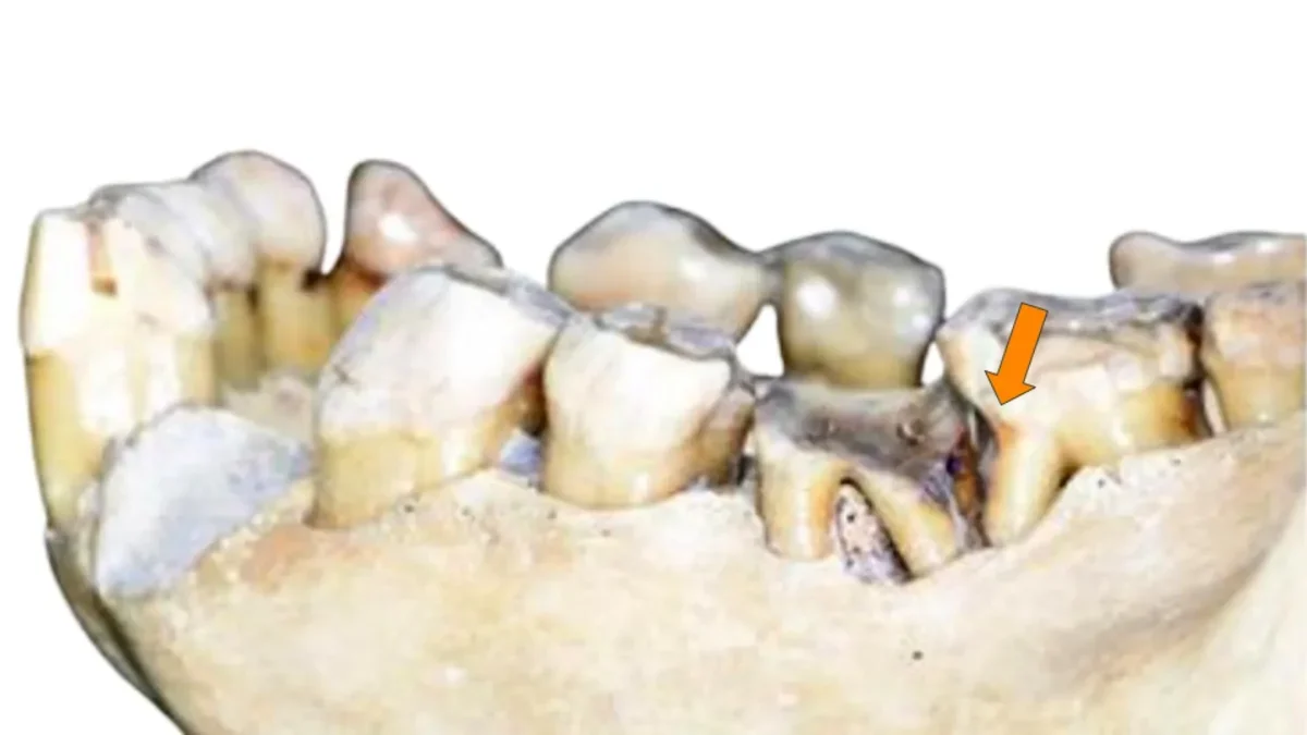 New Insights Challenge Long-Held Beliefs About Human Dental Evolution