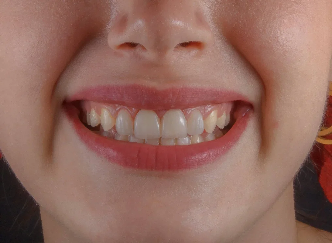 Five-Day Fasting-Style Diet May Ease Gum Inflammation, Study Finds