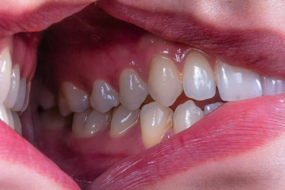 Five-Day Fasting-Style Diet May Help Calm Gum Disease Inflammation