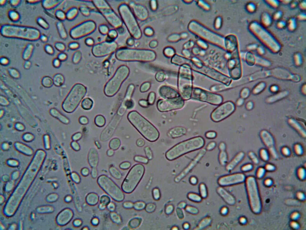 Gut Microbe Research Opens a New Path in Lupus Science