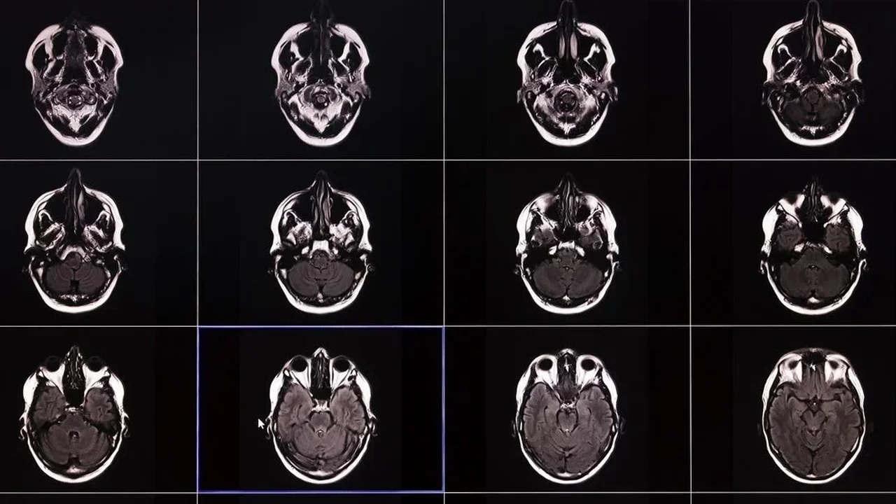 10,000 Brain Scans Reveal Memory Loss Is More Widespread Than Once Thought