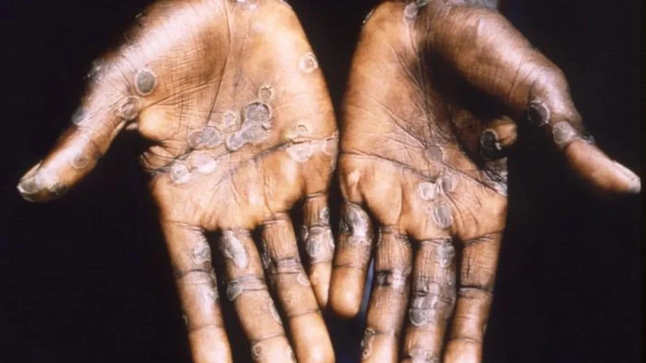 Why Mpox Keeps Reappearing and What Scientists Are Learning