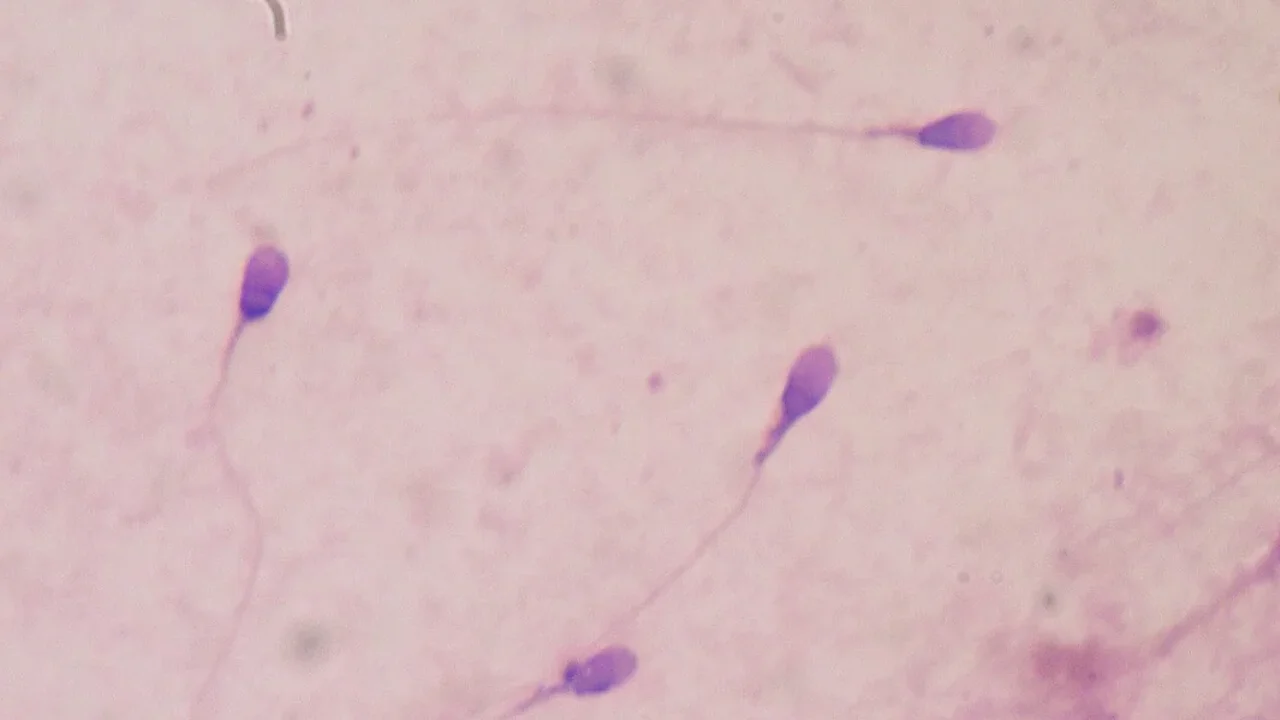 Normal-Looking Sperm May Hide DNA Damage in Recurrent Miscarriage Cases