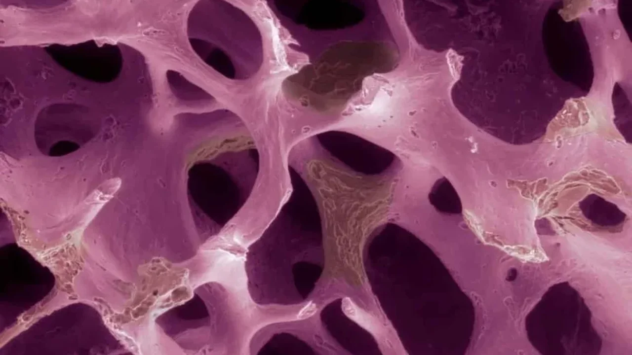 Targeted Cell Therapy Shows Early Promise for Osteoporosis Care